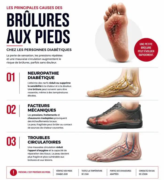 Infographie des causes principales de la sensation de brûlure dans le pied