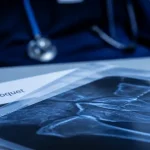 Ostéophytose : becs de perroquet visibles sur radiographie