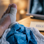 Entorse orteil : strapping et poche de glace sur l’orteil