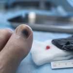 Ongle d’orteil noir : orteil noir ongle en consultation podologique